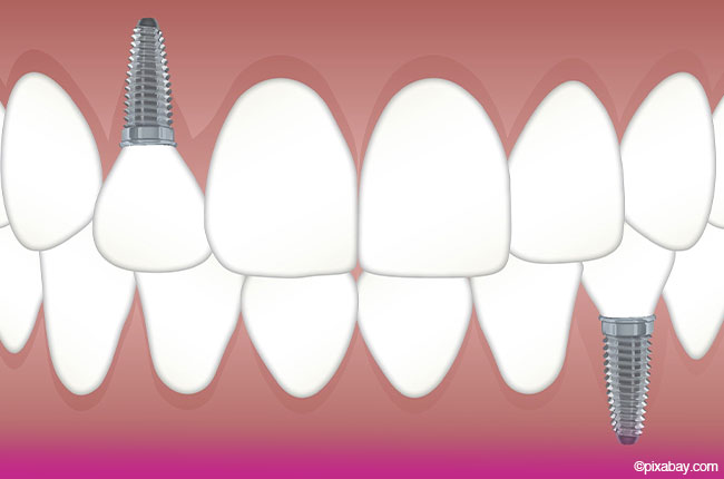 Wie funktioniert ein Zahnimplantat
